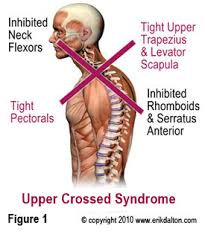 Upper Crossed Syndrome